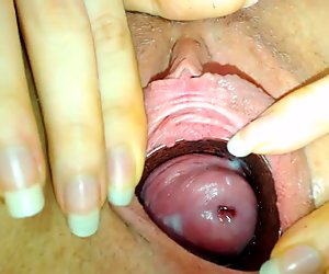 Bealn perhapsn cervix
